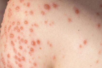 Costa Rica confirma tercer caso de mpox y refuerza la vigilancia epidemiológica