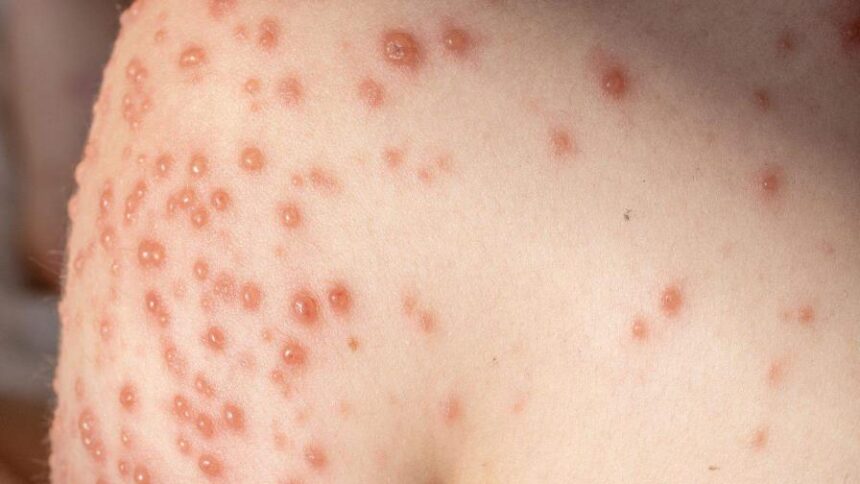 Costa Rica confirma tercer caso de mpox y refuerza la vigilancia epidemiológica